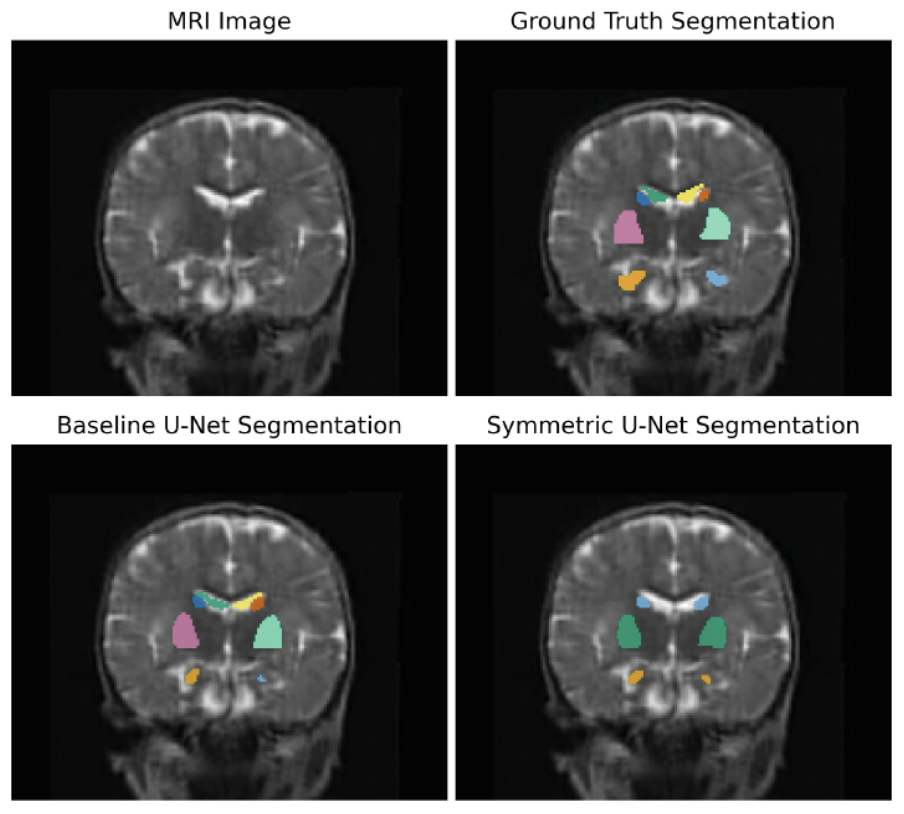 Segmenting Brain Regions in Low Field Pediatric Brain MR Images Using (Symmetric) nnU-Net ResEnc